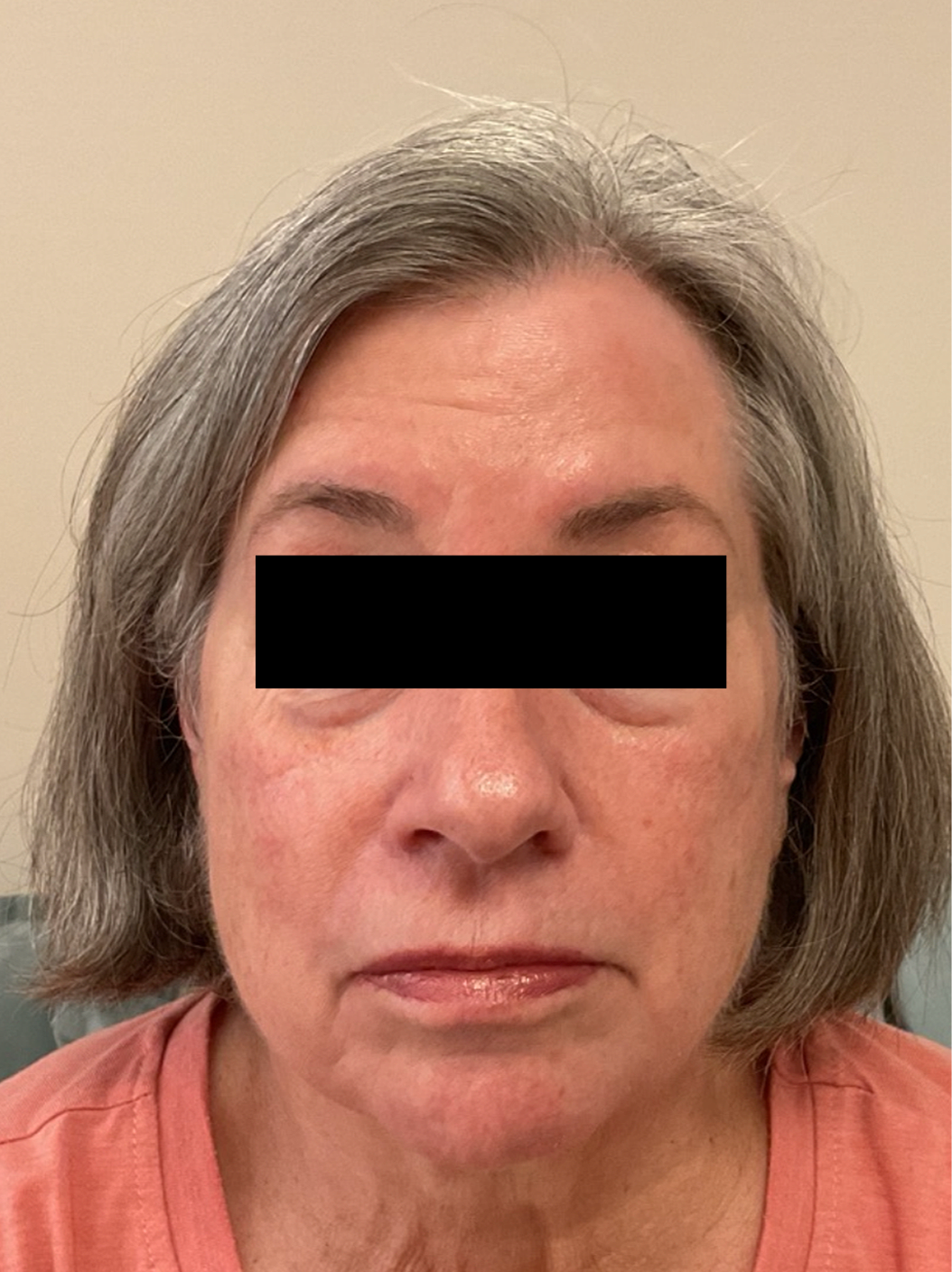 After Image: Botox - front