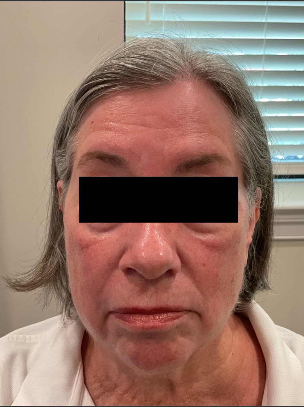 Before Image: Botox - front