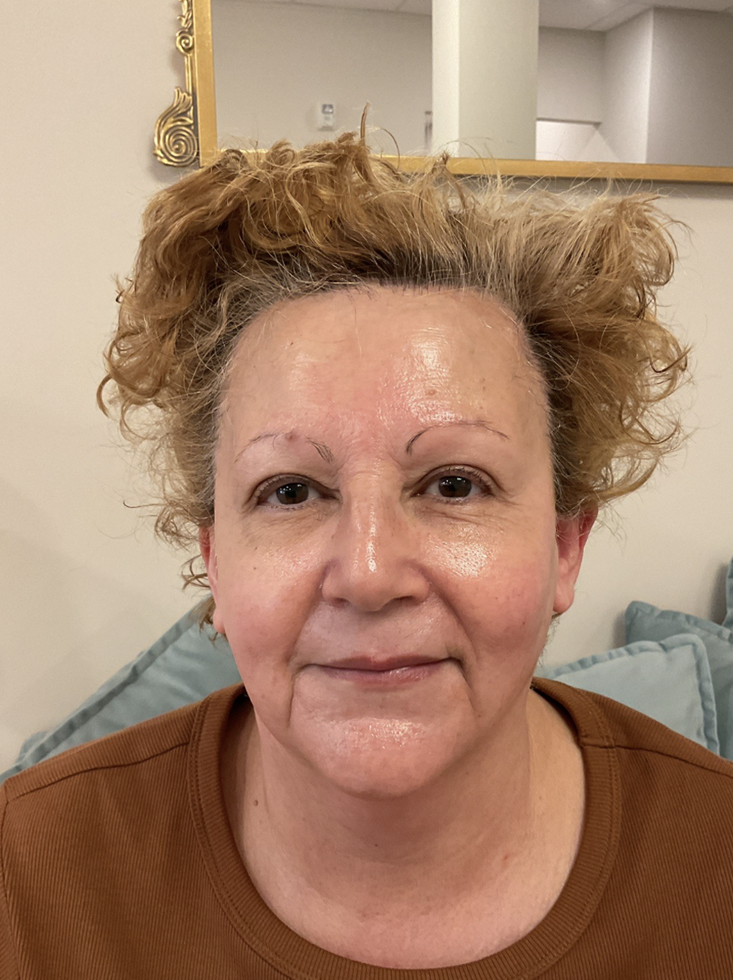 After Image: Radiofrequency Facial - front