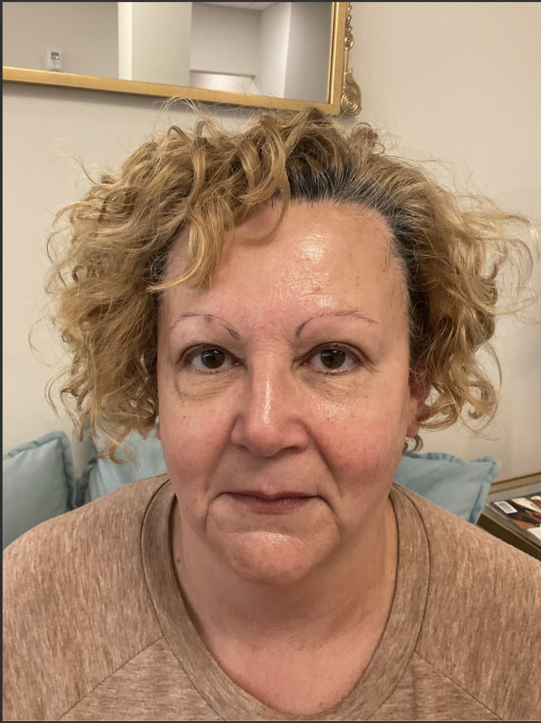 Before Image: Radiofrequency Facial - front